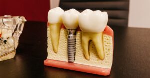 Choosing the Right Tustin Dental Implant Specialist: A Digital Approach